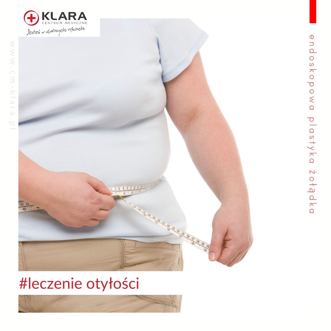 endoskopowa plastyka żołądka