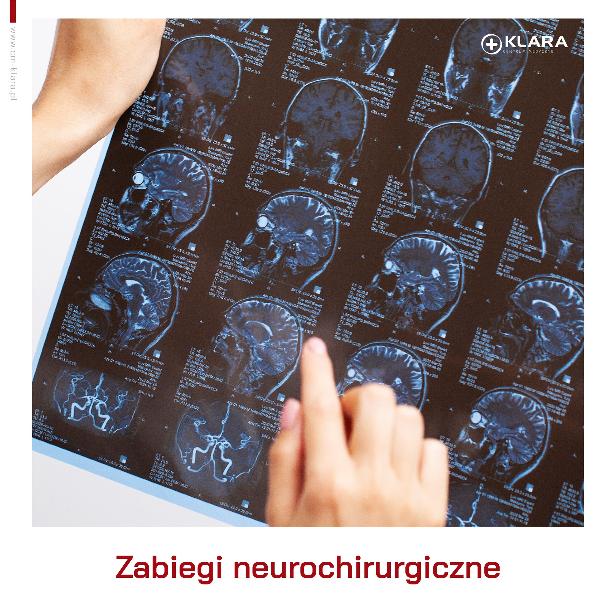 zabiegi neurochirurgiczne